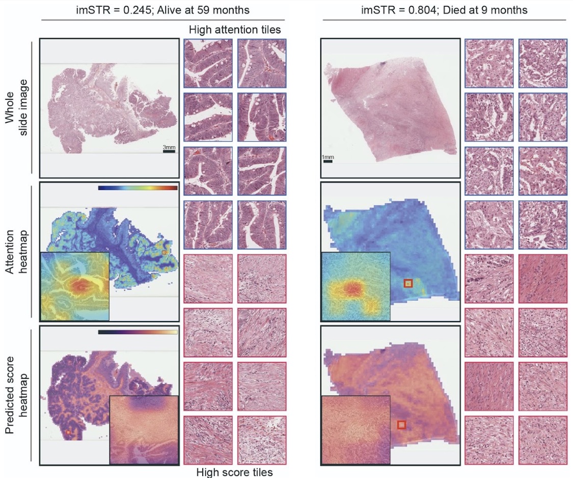 Two patient examples showing whole-slide histopathology images, attention heatmaps, predicted score heatmaps, and the highest-attention and highest-score image tiles.
